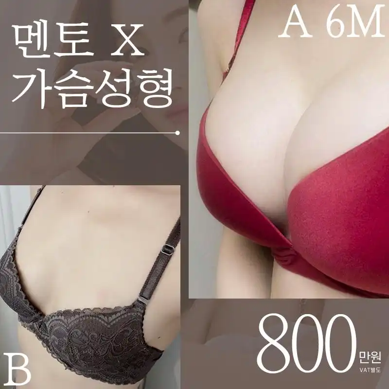 ♥멘토엑스트라 가슴성형♥