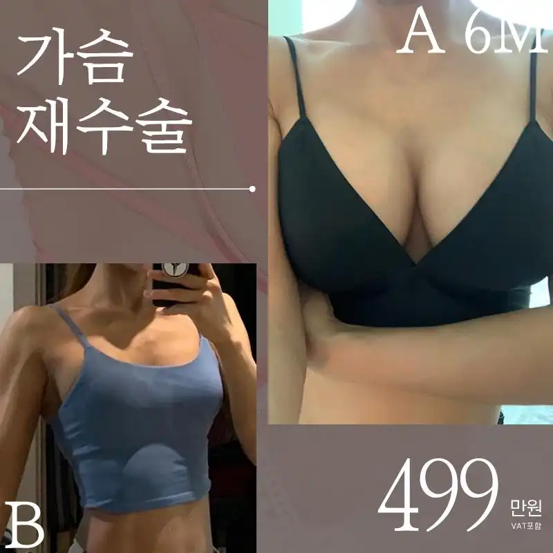 ♥프리티 가슴재수술♥