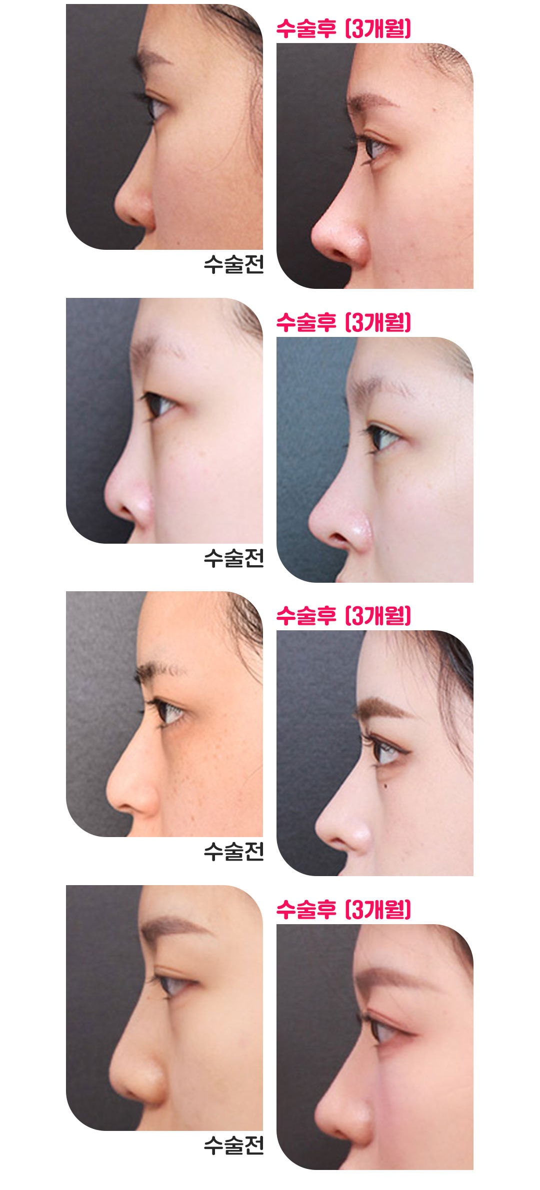 베리굿성형외과의원 베리굿♡MZ코 코성형 이벤트, 시술 상세 이미지