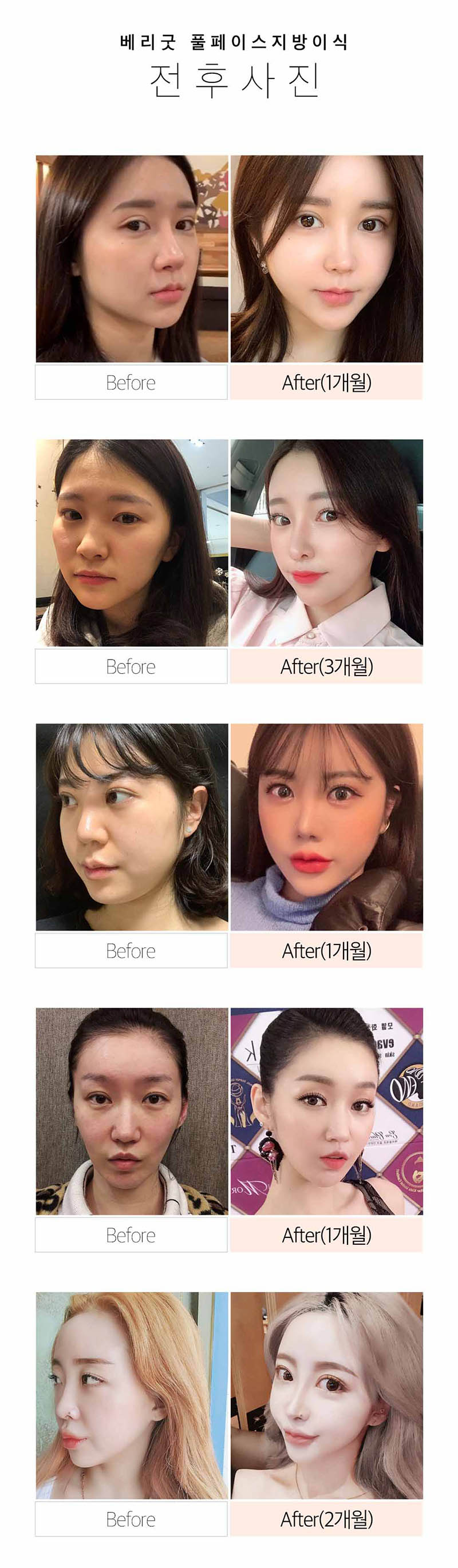 베리굿성형외과의원 베리굿 풀페이스 지방이식 이벤트, 시술 상세 이미지