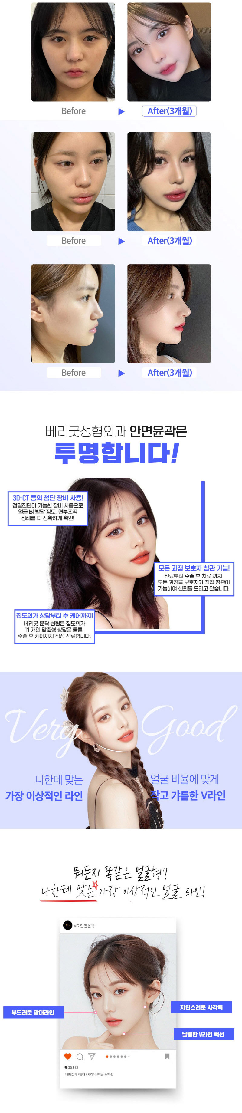 베리굿성형외과의원 베리굿♡추가금없는 안면윤곽 이벤트, 시술 상세 이미지