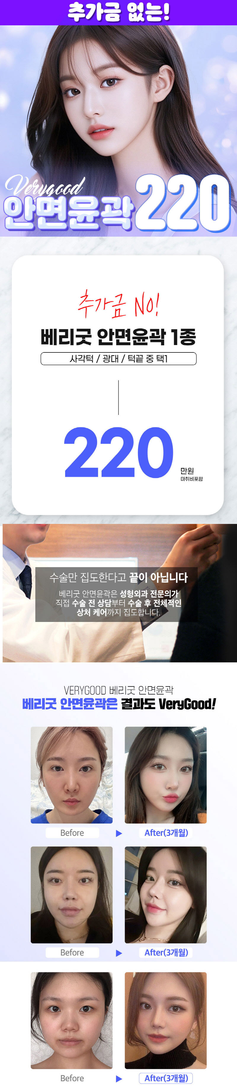 베리굿성형외과의원 베리굿♡추가금없는 안면윤곽 이벤트, 시술 상세 이미지