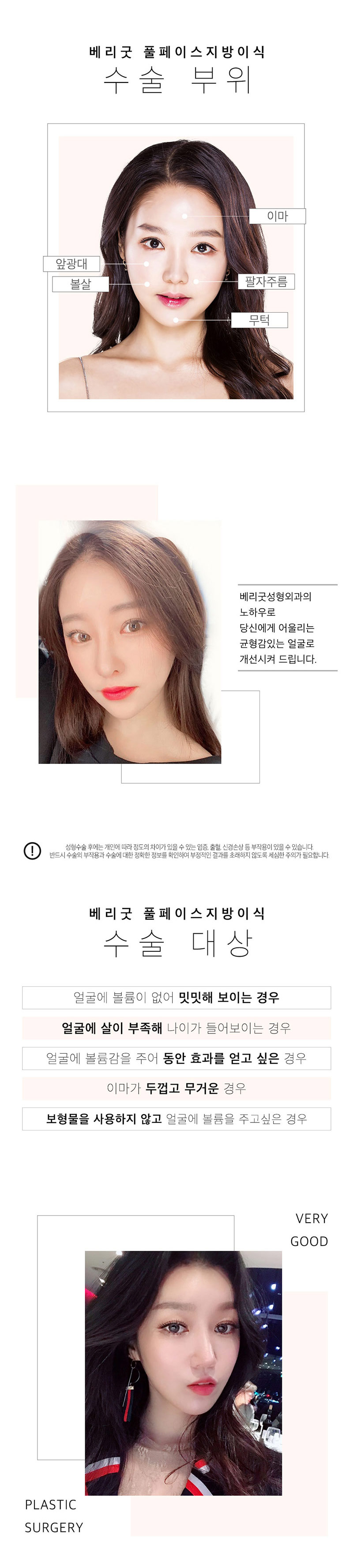 베리굿성형외과의원 베리굿 풀페이스 지방이식 이벤트, 시술 상세 이미지