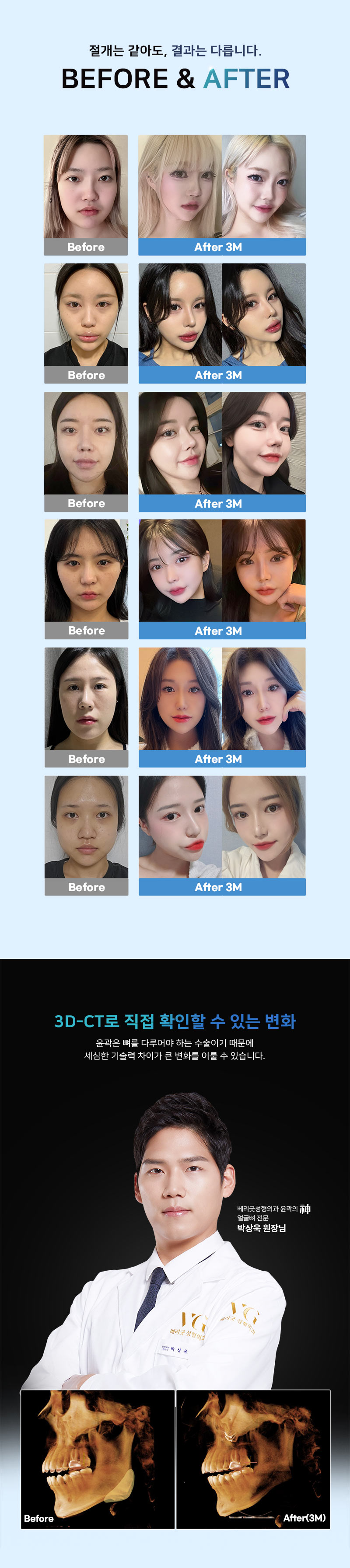베리굿성형외과의원 윤곽의신 안면윤곽 이벤트, 시술 상세 이미지
