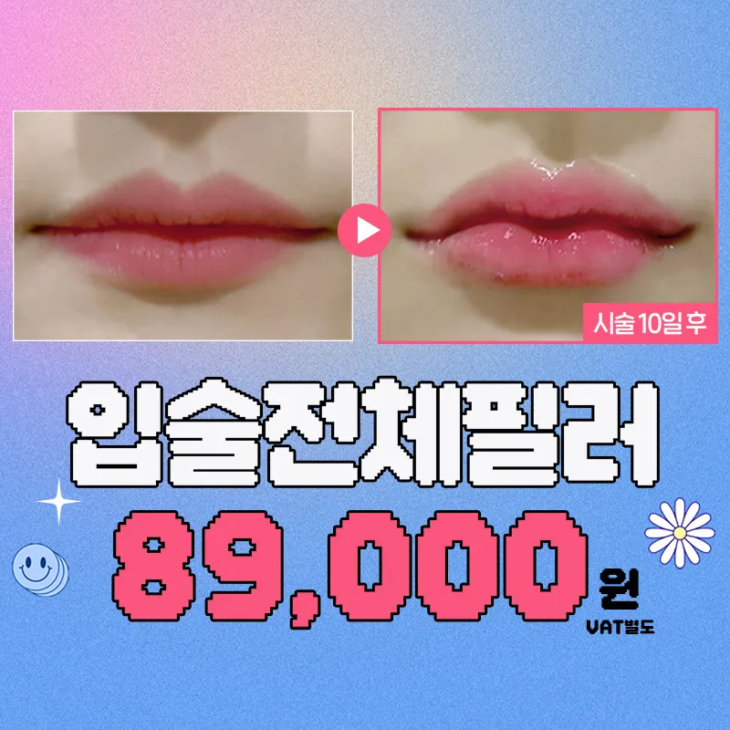 입술전체필러 이벤트 썸네일 이미지