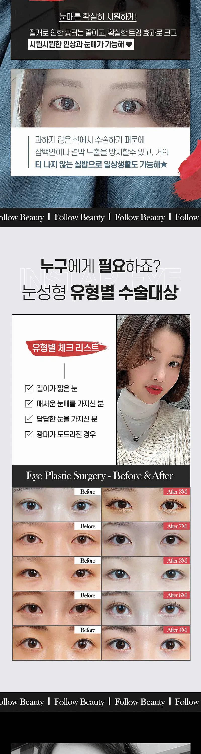인스타성형외과의원 ❣️인스타❣️감쪽트임❣️ 이벤트, 시술 상세 이미지