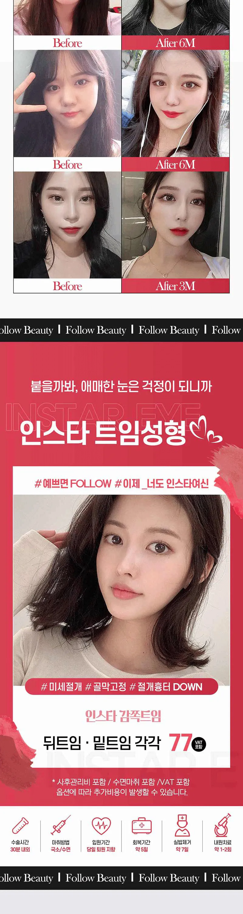 인스타성형외과의원 ❣️인스타❣️감쪽트임❣️ 이벤트, 시술 상세 이미지