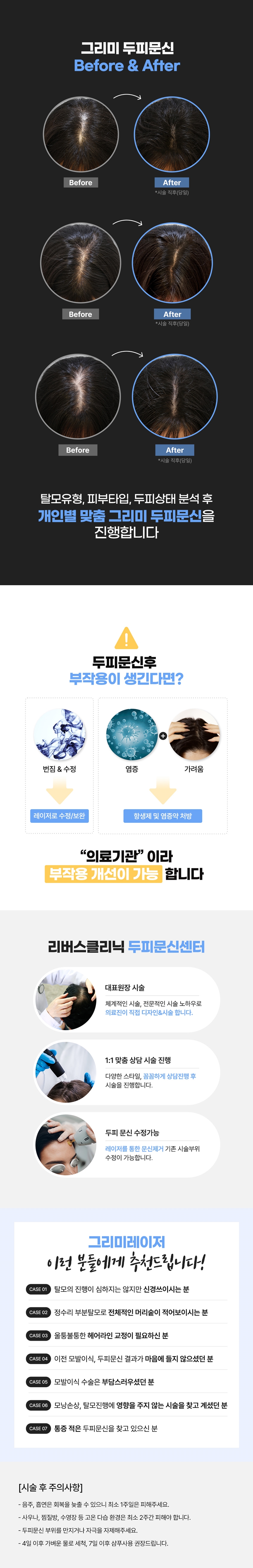 리버스클리닉 강남점 바늘 없는 두피문신레이저 '그리미' 이벤트, 시술 상세 이미지